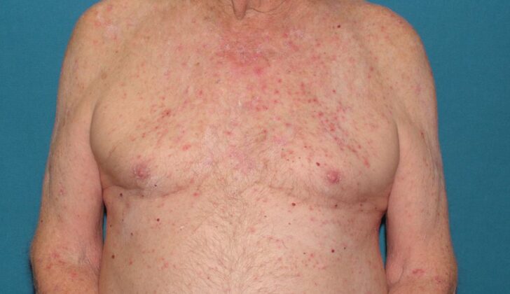 Miliaria, Skin Disease