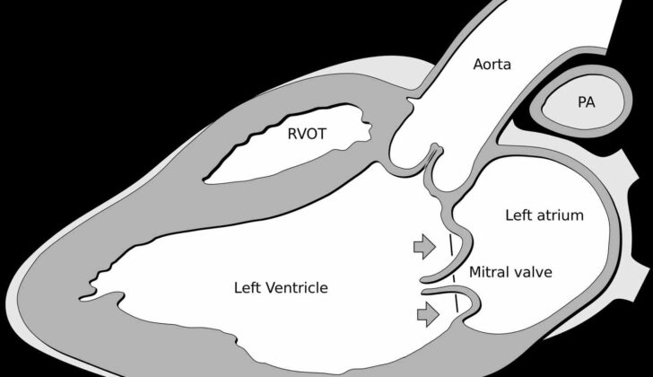 Mitral Valve Prolapse