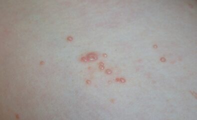 Molluscum Contagiosum