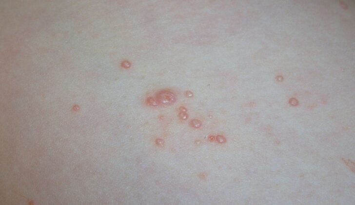 Molluscum Contagiosum
