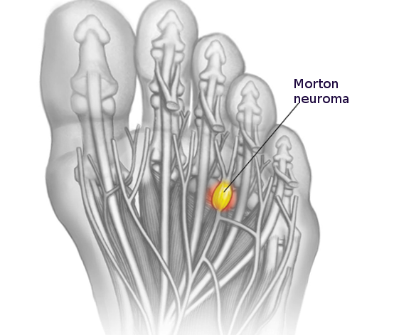 Morton Neuroma