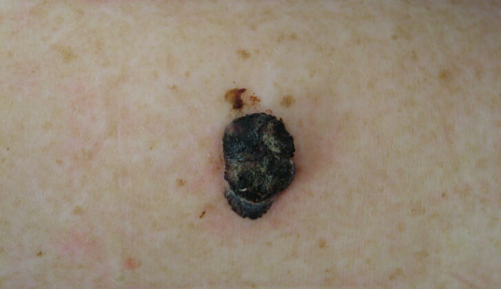 Nodular Melanoma