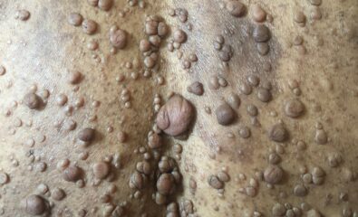 Neurofibromatosis