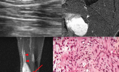 Neurilemmomas