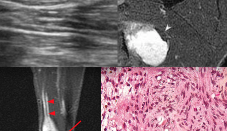 Neurilemmomas