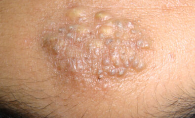 Nevus comedonicus over the forehead