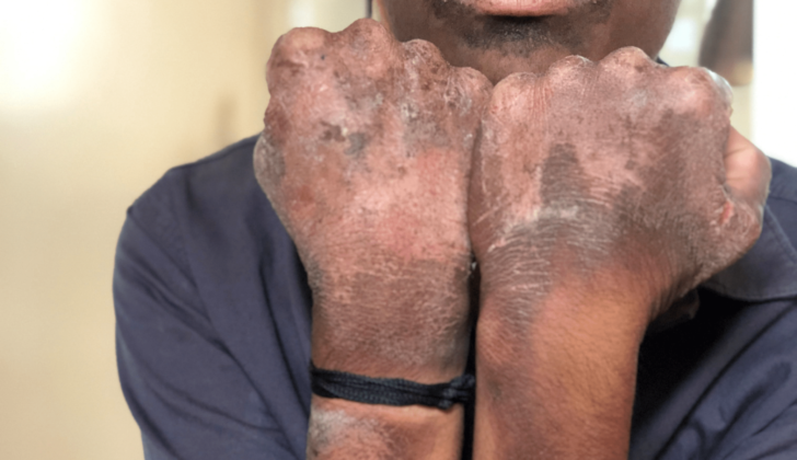 Pellagra Photosensitivity