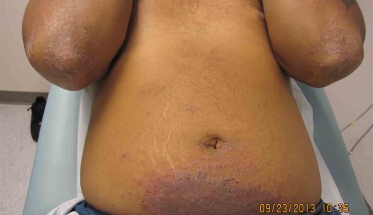 Nickel Contact Dermatitis. A classic presentation of periumbilical nickel contact dermatitis with ID reaction involving elbows.