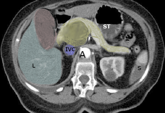 Pancreatic Cancer, Courvoisier Sign. The Courvoisier Sign, characteristically seen in pancreatic cancer, is shown on magnetic resonance imaging.
