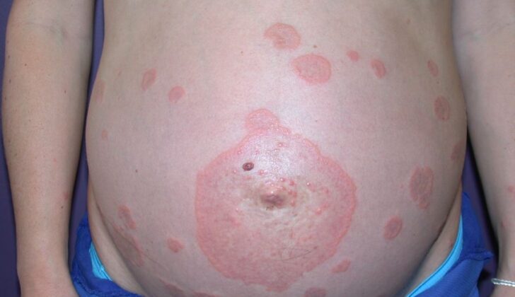 Abdominal Pemphigoid Gestationis