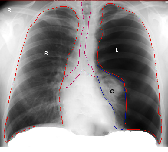 Left Tension Pneumothorax Radiograph. The left lung (marked