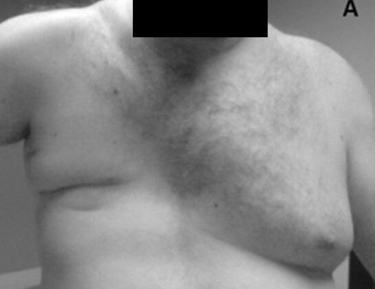 Poland Syndrome With Absence of Pectoralis Major Muscle