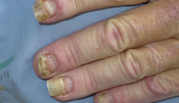 Nail Psoriasis