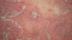 Pustular Psoriasis. Pustular psoriasis is a rare and extreme form of psoriasis characterized by the appearance of sterile pustules, which can take many patterns.