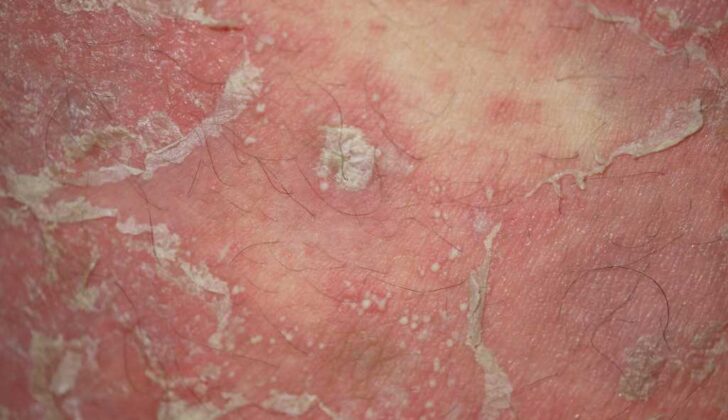 Pustular Psoriasis. Pustular psoriasis is a rare and extreme form of psoriasis characterized by the appearance of sterile pustules, which can take many patterns.