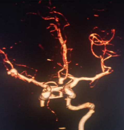 Multiple Intracranial Saccular Aneurysms. Aneurysms of the anterior
communicating artery and middle cerebral artery bifurcation are visualized.