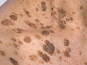 Seborrheic Keratosis