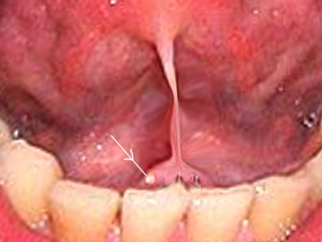 Submandibular Stone. If large enough, these stones may be visually apparent on
examination of the oral cavity.