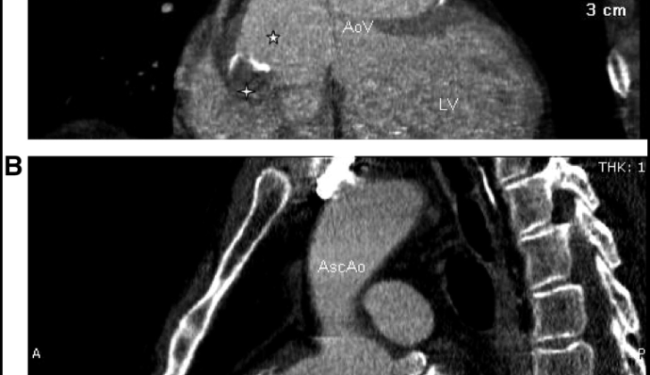 Sinus of Valsalva Aneurysm. Computed tomographic coronal (A) and sagittal (B) views demonstrating the named finding. Shows layered thrombus within the aneurysms of sinuses of Valsaalva; ☆, dilated sinuses of Valsalva. Asc Ao indicates ascending thoracic aorta; AoV, aortic valve; and LV, left ventricle.