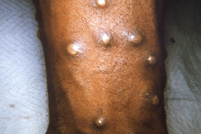 Pathology, Maculopapular lesions, arm, Smallpox Virus, Pustular phase, Variola
major and minor