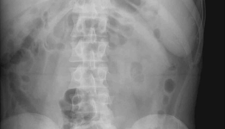 Abdominal Radiograph of Splenomegaly. Splenomegaly is visualized on an abdominal x-ray.