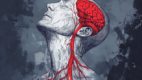 Subclavian Steal Syndrome, a condition where blood flow to the brain is reduced due to a blockage or narrowing of the subclavian artery.