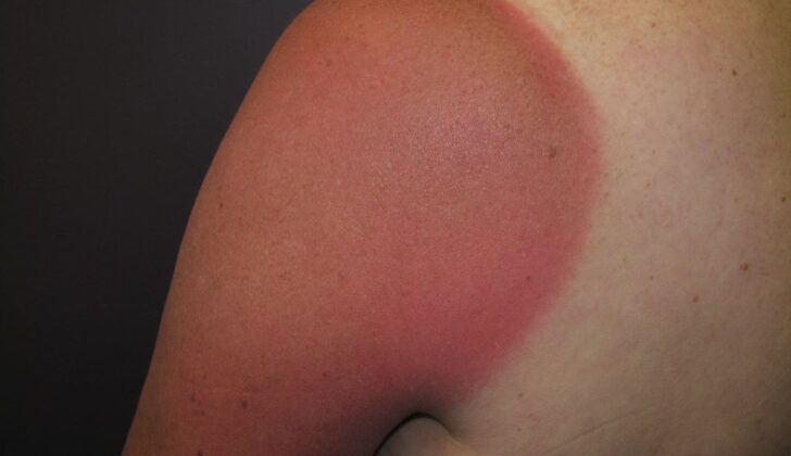 Sunburn, Shoulder