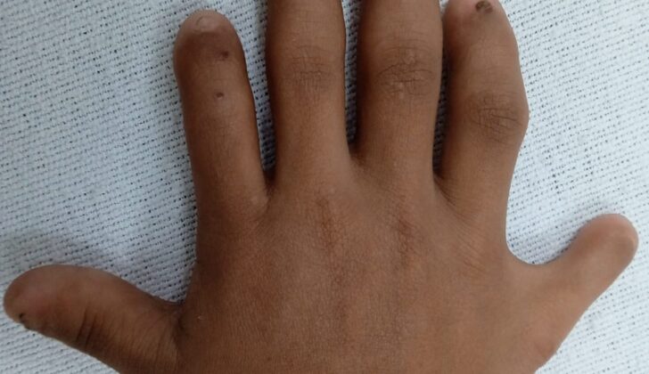 Postaxial polydactyly