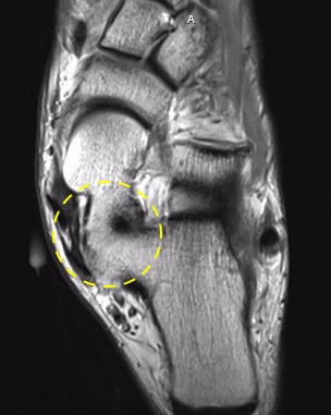 Talocalcaneal Coalition on MRI. T1 MRI demonstrating middle facet subtalar joint osseous coalition on axial images.