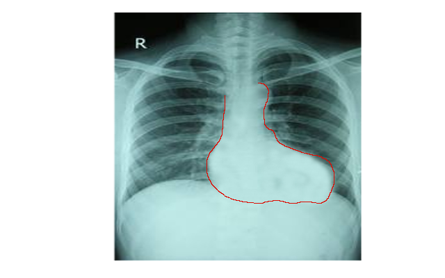 Chest X-ray of Tetralogy of Fallot