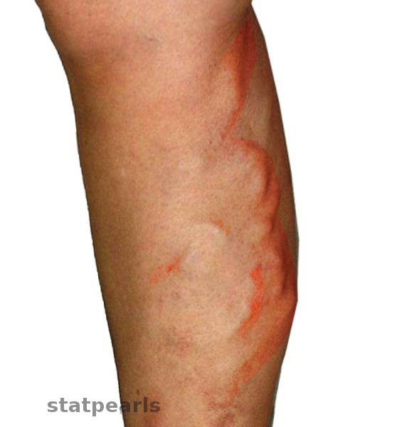Migratory Thrombophlebitis