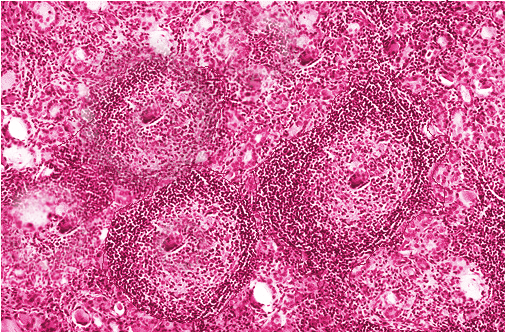 Hashimoto Thyroiditis