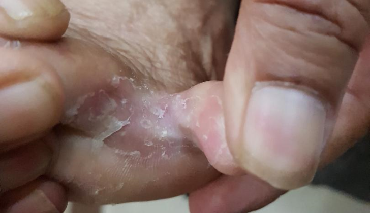 Tinea pedis