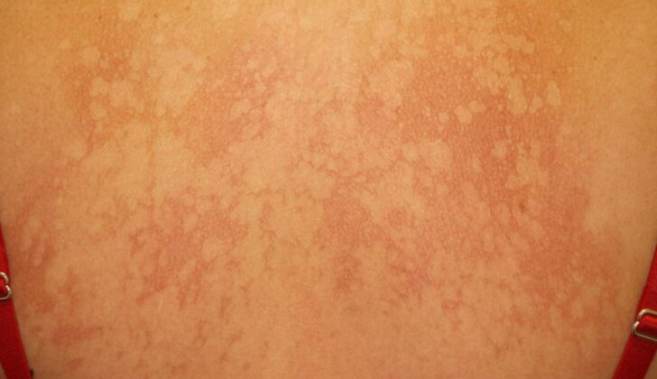 Pityriasis Versicolor