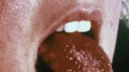 Strawberry Tongue. Image of strawberry tongue caused by Staphylococcus aureus in a patient with toxic shock syndrome.