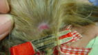 Traction alopecia