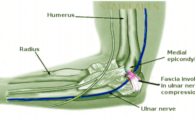 Ulnar Nerve Entrapment - MD Searchlight