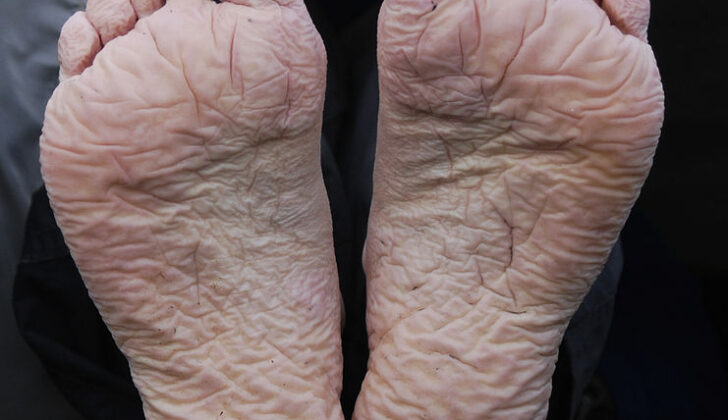 Trench Foot