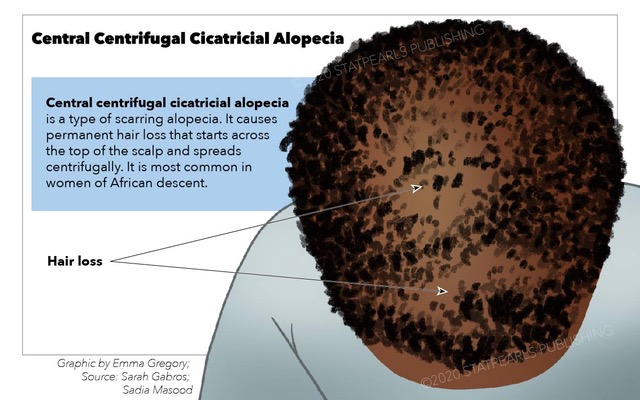Central Centrifugal Cicatricial Alopecia. Central centrifugal cicatricial alopecia exhibiting a centrifugal hair-loss pattern in a female patient.