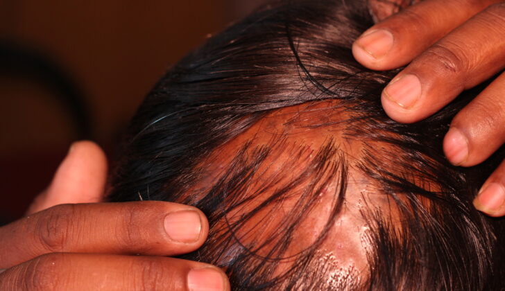Patient With Lesions of Lichen Planopilaris. Diffuse, multiple scalp lesions in a patient with lichen planopilaris.  