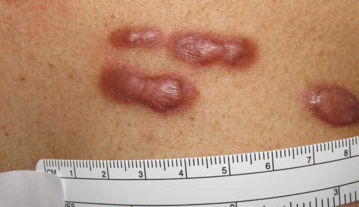 Keloid Scars