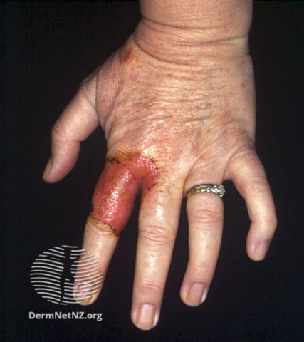 Tinea manuum. Fig 2