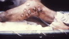 Seen from a medial view, the right leg of this patient in the region of the knee, displayed numerous cutaneous lesions that were diagnosed as the result of a disease process known as actinomycosis, or mycetoma, caused by the Gram-positive, fungus-like aerobic bacteria of the order Actinomycetales. Mycetoma is a slowly progressive, destructive infection of the cutaneous and subcutaneous tissues, fascia, and can progress to a point where it can affect bone as well.