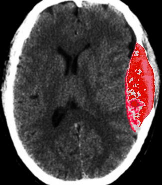 Epidural Hematoma After Trauma, Computed Tomography. The area highlighted in red
depicts an epidural hematoma post-trauma on computed tomography scan.