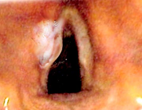 Laryngeal Cancer