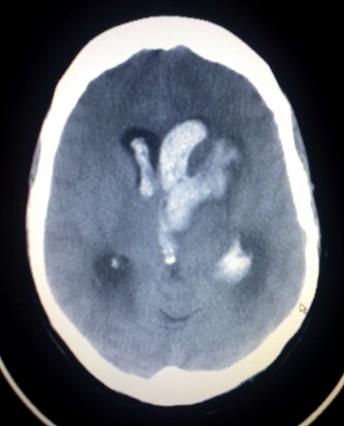 Intracerebral Hemorrhage With Intraventricular Bleeding. Intracerebral
hemorrhage is observed with intraventricular bleeding on the head CT of a
patient.
