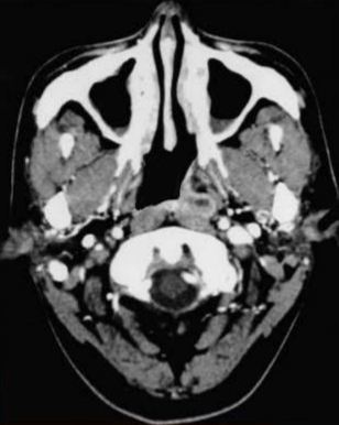 Nasopharyngeal Mass. CT image of a patient with a left-sided nasopharyngeal mass
involving the posterior pharyngeal wall and showing minor opacification of the
maxillary antrum bilateral.