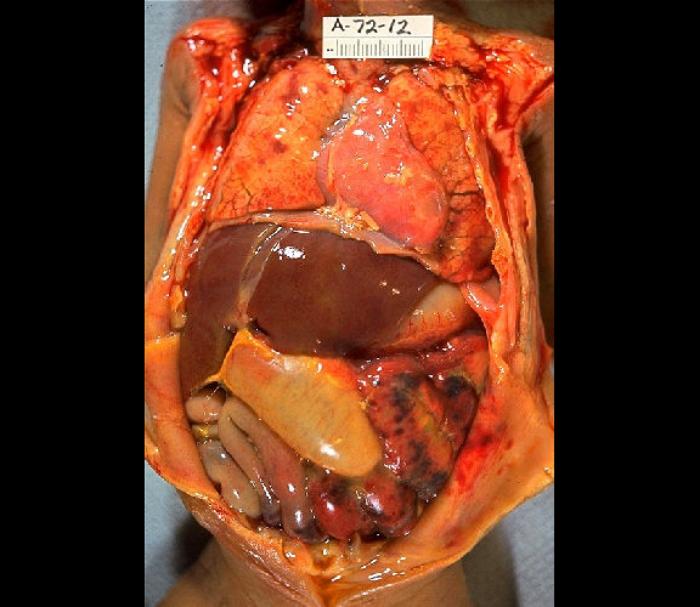 Gross Pathology of Neonatal Necrotizing Enterocolitis. Autopsy of an infant with
abdominal distention, necrosis, hemorrhage, and peritonitis due to perforation.
