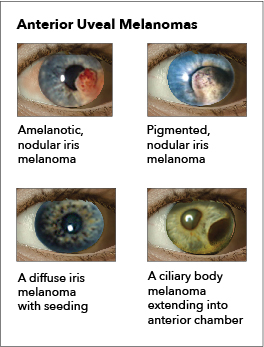 Ocular Melanoma. The image depicts various presentations of anterior uveal
melanoma.