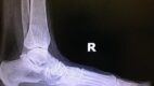 Pes Planus Note the lack of the longitudinal arch, increased talar declination, and decreased calcaneal pitch.
